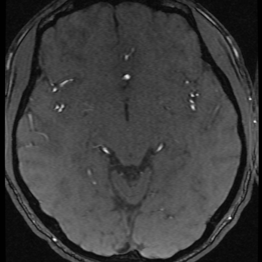 Azygos anterior cerebral artery (Radiopaedia 17059-16756 Axial MRA 30).jpg