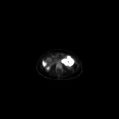 B-cell lymphoma of the mesentery (Radiopaedia 65743-74868 18F-FDG PET-CT 132).jpg