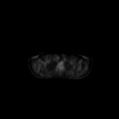 B-cell lymphoma of the mesentery (Radiopaedia 65743-74868 18F-FDG PET-CT 231).jpg