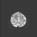 Balo concentric sclerosis (Radiopaedia 50458-55940 Axial DWI 26).jpg