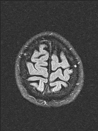 File:Balo concentric sclerosis (Radiopaedia 50458-55940 Axial FLAIR 4).jpg