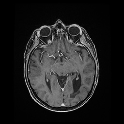Balo concentric sclerosis (Radiopaedia 53875-59982 Axial LAVA C+ 118).jpg