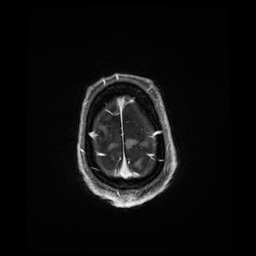Balo concentric sclerosis (Radiopaedia 53875-59982 Axial LAVA C+ 241).jpg