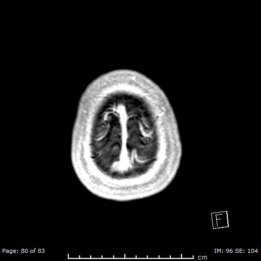 Balo concentric sclerosis (Radiopaedia 61637-69636 Axial T1 C+ 80).jpg