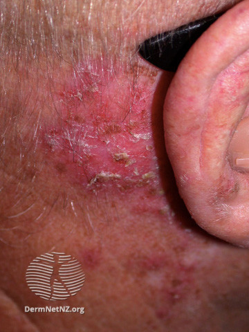 Basal cell carcinoma affecting the face (DermNet NZ lesions-bcc-face-1236).jpg