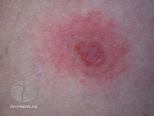File:Basal cell carcinoma affecting the trunk (DermNet NZ lesions-bcc-trunk-1023).jpg