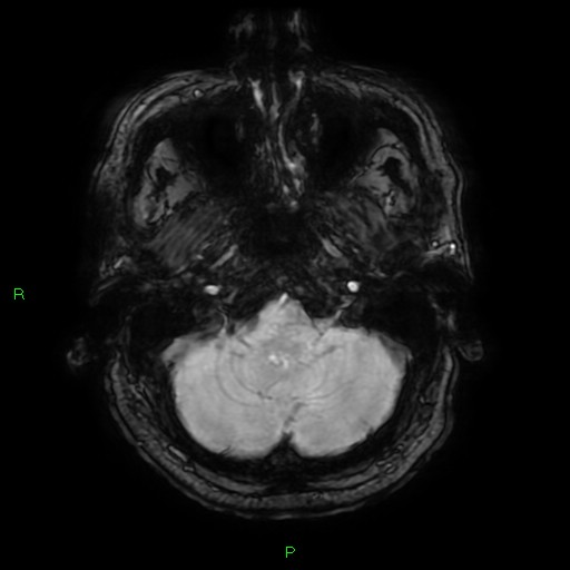 Basal ganglia hemorrhage (Radiopaedia 58346-65468 Axial SWI 10).jpg