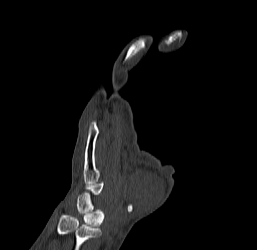 Base of 2nd metacarpal fracture (Radiopaedia 73741-84544 Coronal bone window 32).jpg