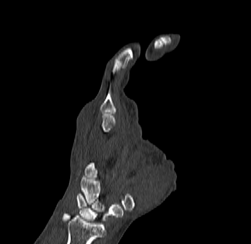 Base of 2nd metacarpal fracture (Radiopaedia 73741-84544 Coronal bone window 39).jpg