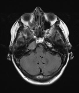 File:Base of skull chondrosarcoma (Radiopaedia 30410-31070 Axial FLAIR 5).jpg