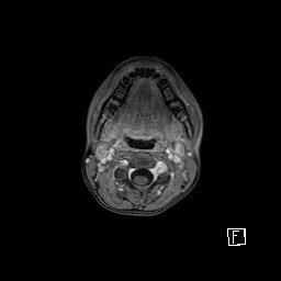 Base of skull rhabdomyosarcoma (Radiopaedia 32196-33142 T1 C+ fat sat 8).jpg