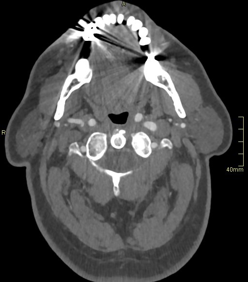 Basilar artery aneurysm (Radiopaedia 56261-62932 A 22).jpg