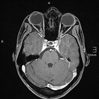 Basilar artery perforator aneurysm (Radiopaedia 82455-99523 G 42).jpg