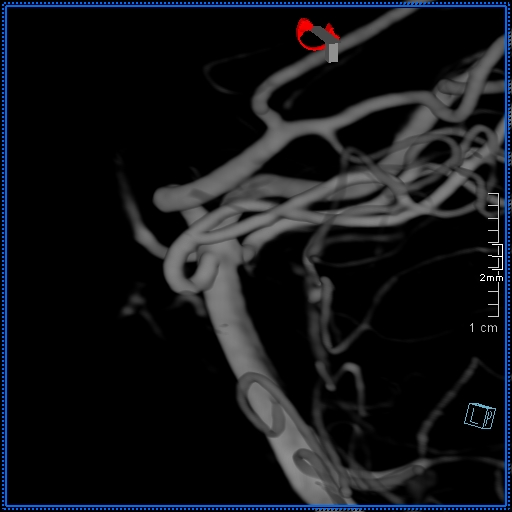 Basilar artery perforator aneurysm (Radiopaedia 82455-99524 3D Left VA 15).jpg