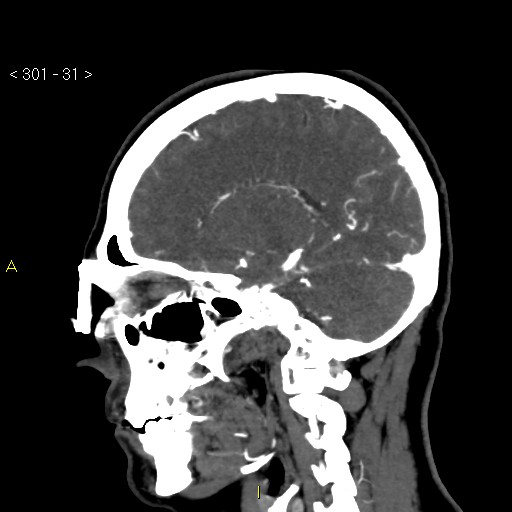 Basilar artery thrombosis (Radiopaedia 16260-15944 C 25).jpg