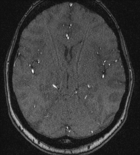 Basilar tip aneurysm (Radiopaedia 26504-26632 MRA 114).jpg