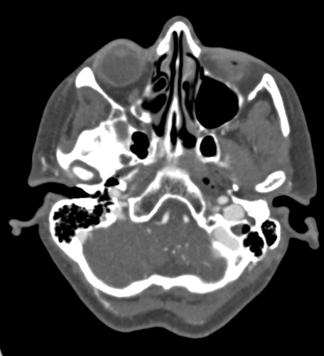 File:Basilar tip aneurysm with coiling (Radiopaedia 53912-60086 A 27).jpg