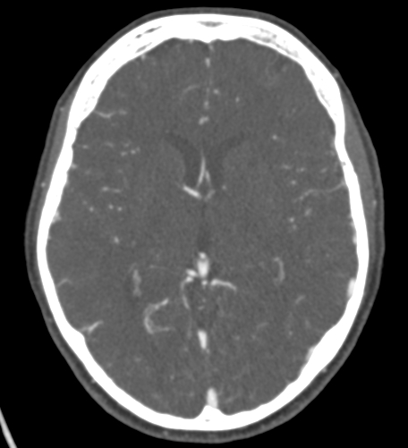 Basilar tip aneurysm with coiling (Radiopaedia 53912-60086 A 77).jpg