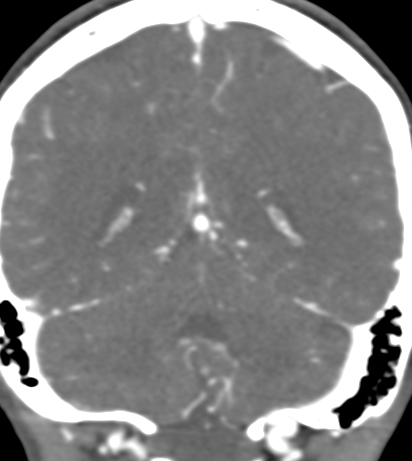 Basilar tip aneurysm with coiling (Radiopaedia 53912-60086 B 110).jpg