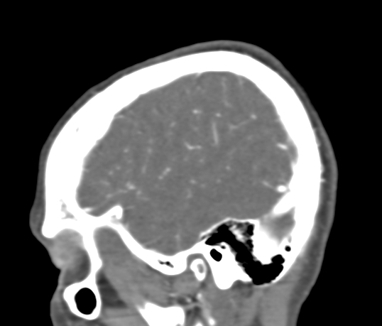 Basilar tip aneurysm with coiling (Radiopaedia 53912-60086 C 18).jpg