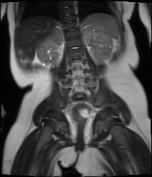 File:Beckwith-Wiedeman syndrome with bilateral Wilms tumors (Radiopaedia 60850-69233 Coronal T2 12).jpg