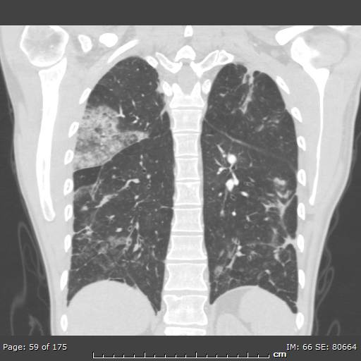 Behçet disease (Radiopaedia 44247-47889 Coronal lung window 15).jpg