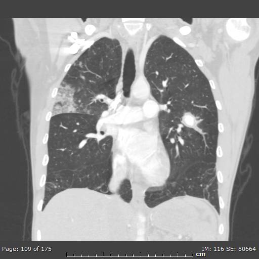 Behçet disease (Radiopaedia 44247-47889 Coronal lung window 33).jpg