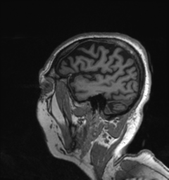 Behavioral variant frontotemporal dementia and late onset schizophrenia (Radiopaedia 52197-58083 Sagittal T1 5).png
