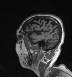 File:Behavioral variant frontotemporal dementia and late onset schizophrenia (Radiopaedia 52197-58083 Sagittal T1 6).png