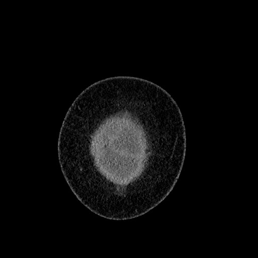 Benign leiomyoma with hydropic features (Radiopaedia 89250-106130 B 5).jpg