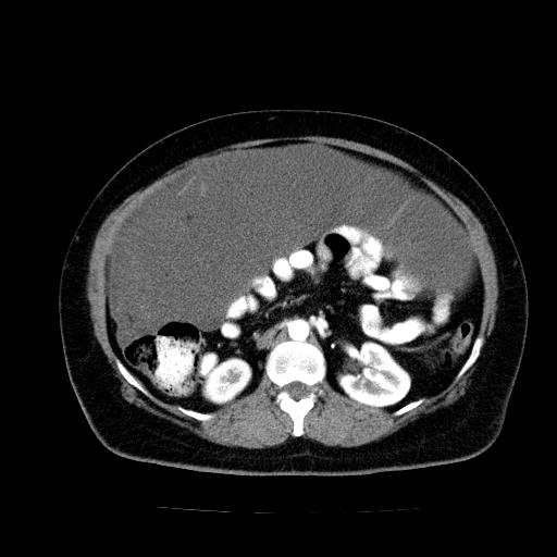 File:Benign spindle cell tumor - abdominopelvic (Radiopaedia 61300-69212 A 26).jpg