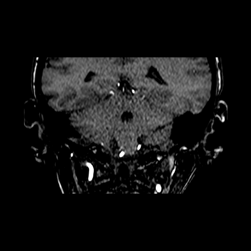 File:Berry aneurysm of the terminal internal carotid artery (Radiopaedia 88286-104918 Coronal TOF 75).jpg