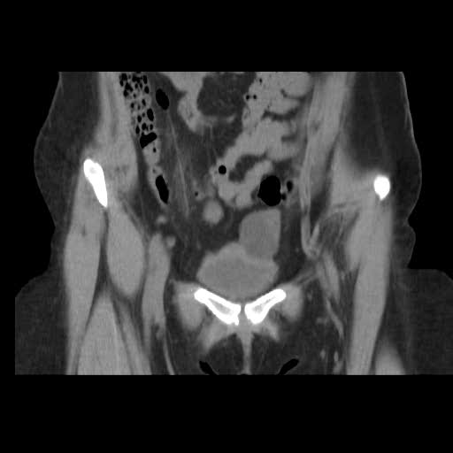 File:Bicornuate uterus (MRI) (Radiopaedia 49206-54296 Coronal 17).jpg