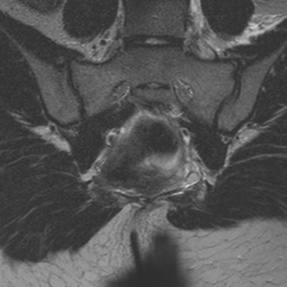 File:Bicornuate uterus (Radiopaedia 24677-24949 Coronal T2 20).jpg