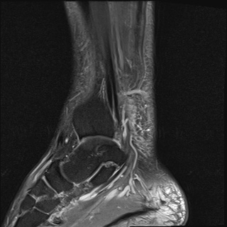 File:Bilateral Achilles tendon complete tear (Radiopaedia 81344-95051 Sagittal T2 fat sat 13).jpg