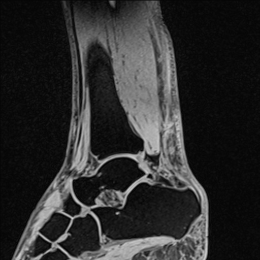 File:Bilateral Achilles tendon complete tear (Radiopaedia 81344-95051 Sagittal WE - Left 70).jpg