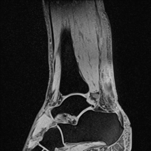Bilateral Achilles tendon complete tear (Radiopaedia 81344-95051 Sagittal WE - Right 46).jpg