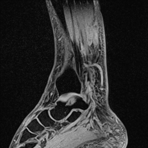 File:Bilateral Achilles tendon complete tear (Radiopaedia 81344-95051 Sagittal WE - Right 74).jpg