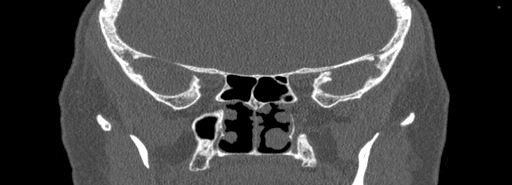 Bilateral Ectopic Infraorbital Nerves (Radiopaedia 49006-54084 Coronal bone window 60).jpg