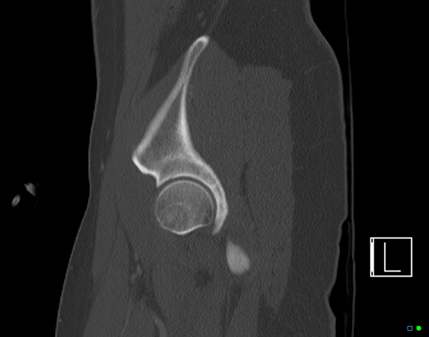 Bilateral acetabular fractures (Radiopaedia 79272-92308 Sagittal bone window 17).jpg