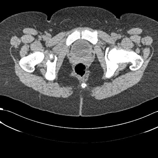 File:Bilateral acetabular protrusion with pincer type femoro-acetabular impingement (Radiopaedia 30134-30733 AXIAL SOFT THIN 67).jpg