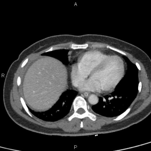 Bilateral adrenal gland hyperenhancement in pancreatitis (Radiopaedia 86642-102753 E 3).jpg