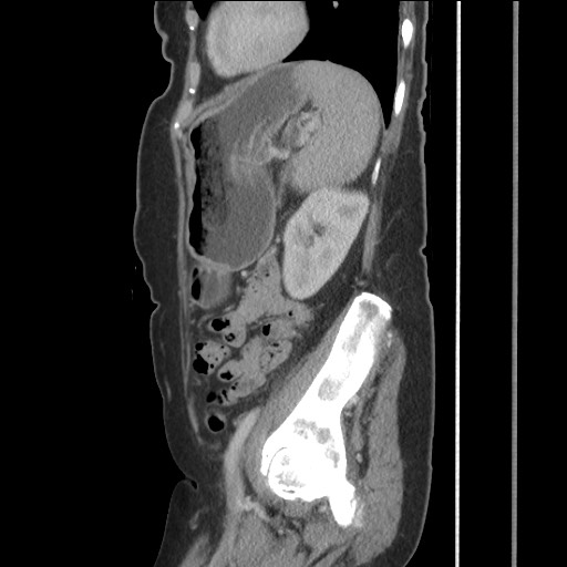 Bilateral adrenal granulocytic sarcomas (chloromas) (Radiopaedia 78375-91007 C 101).jpg