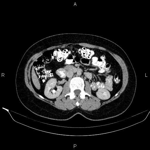 Bilateral adrenal myelolipoma (Radiopaedia 63058-71535 Axial C+ delayed 58).jpg