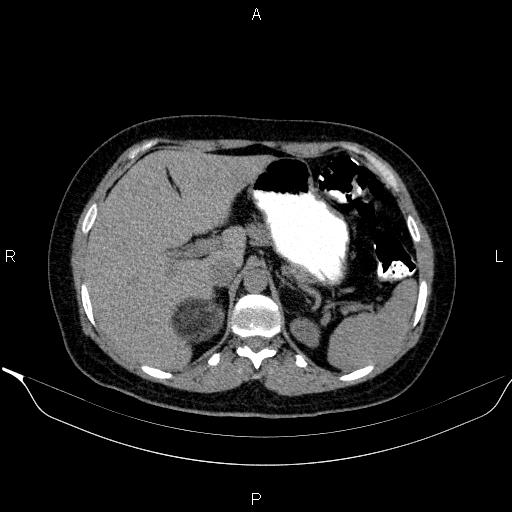 Bilateral adrenal myelolipoma (Radiopaedia 63058-71535 Axial non-contrast 41).jpg