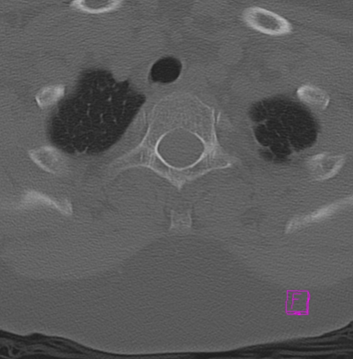 File:Bilateral atlanto-occipital assimilation (Radiopaedia 28350-28603 Axial bone window 46).jpg