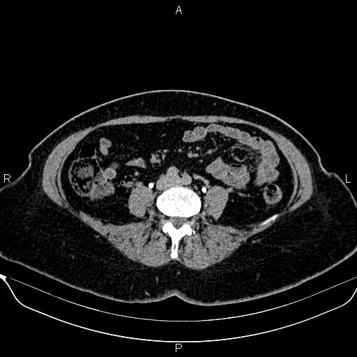 Bilateral benign adrenal adenomas (Radiopaedia 86912-103124 Axial C+ delayed 99).jpg