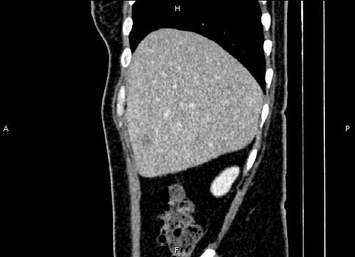 Bilateral benign adrenal adenomas (Radiopaedia 86912-103124 E 17).jpg
