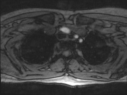 Bilateral carotid body tumors and right glomus jugulare tumor (Radiopaedia 20024-20060 Axial MRA 171).jpg