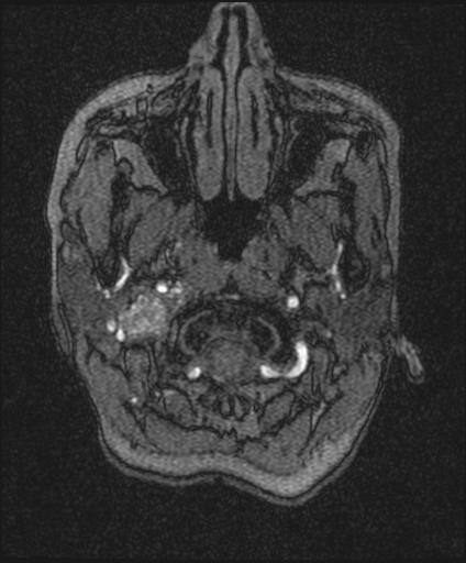 Bilateral carotid body tumors and right glomus jugulare tumor (Radiopaedia 20024-20060 Axial MRA 5).jpg